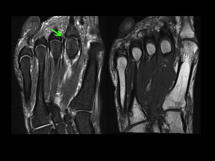 Figure 3 for case Freibergs Infraction with 2nd MTPJ plantar plate and lateral capsule tear